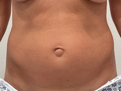 Tummy Tuck Before & After Gallery - Patient 826880 - Image 1