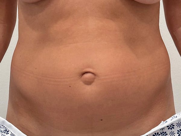 Tummy Tuck Before & After Gallery - Patient 826880 - Image 1