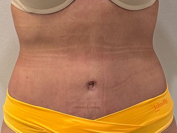 Tummy Tuck Before & After Gallery - Patient 826880 - Image 2