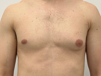 Gynecomastia Before & After Gallery - Patient 417588 - Image 1