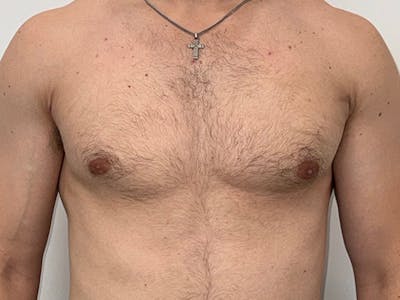 Gynecomastia Before & After Gallery - Patient 417588 - Image 2