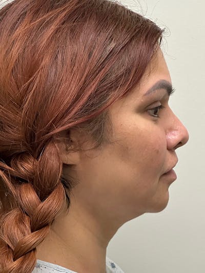 Facelift Before & After Gallery - Patient 271821 - Image 1