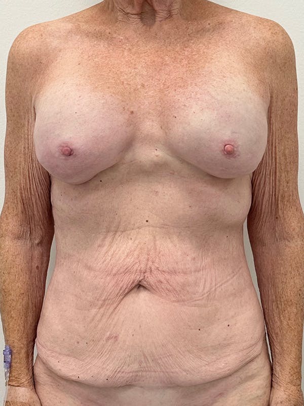 Tummy Tuck Before & After Gallery - Patient 730217 - Image 1