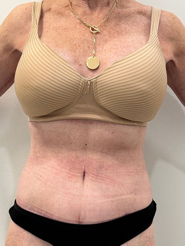 Liposuction Before & After Gallery - Patient 419250 - Image 2