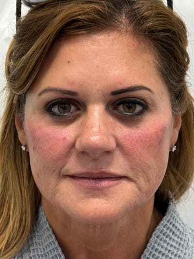 Dermal Fillers Before & After Gallery - Patient 421243 - Image 2
