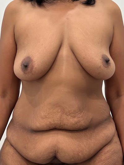 Tummy Tuck Before & After Gallery - Patient 333862 - Image 1