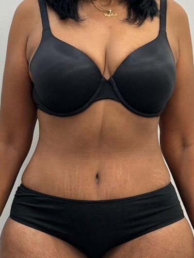 Tummy Tuck Before & After Gallery - Patient 333862 - Image 2