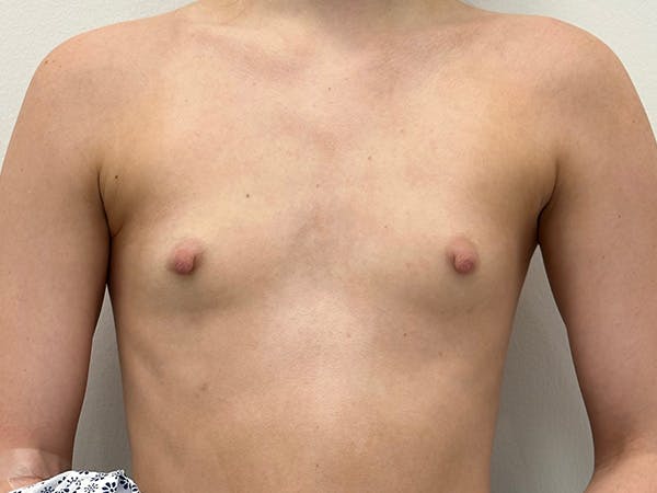 Breast Augmentation Before & After Gallery - Patient 235886 - Image 1