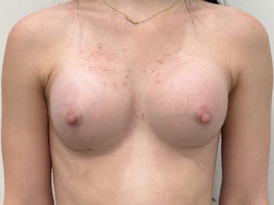 Breast Augmentation Before & After Gallery - Patient 235886 - Image 2