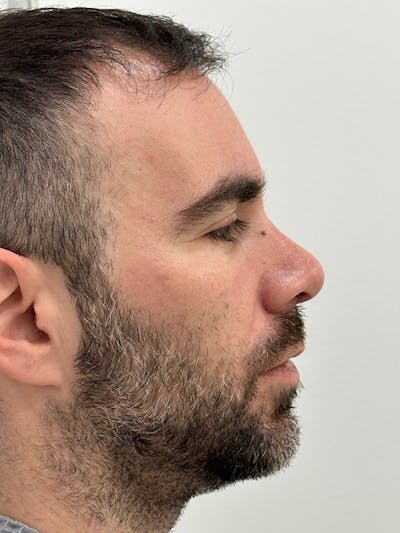 Rhinoplasty Before & After Gallery - Patient 218427 - Image 6