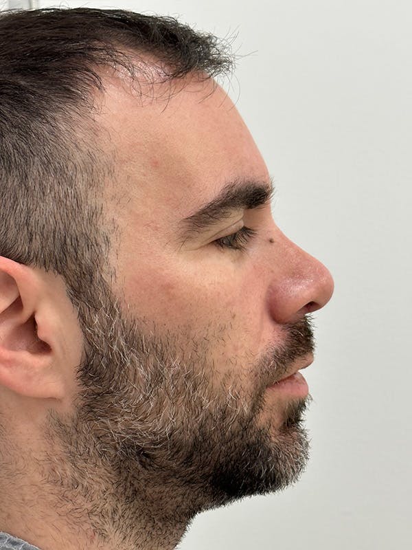 Rhinoplasty Before & After Gallery - Patient 218427 - Image 6
