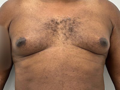 Gynecomastia Before & After Gallery - Patient 201898 - Image 1