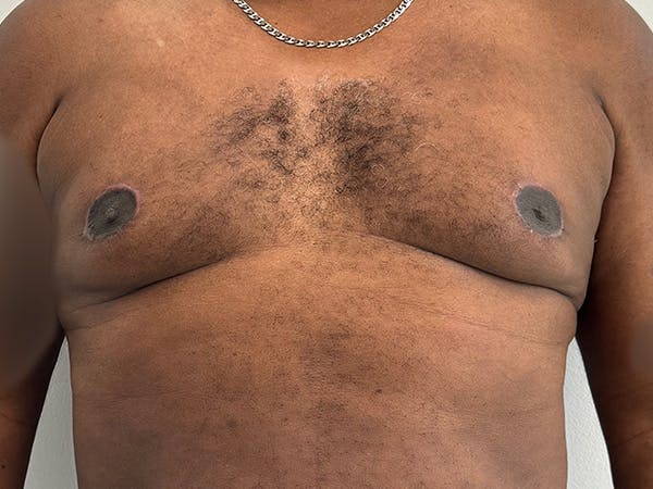 Gynecomastia Before & After Gallery - Patient 201898 - Image 2