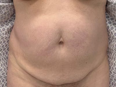 Tummy Tuck Before & After Gallery - Patient 210110 - Image 1