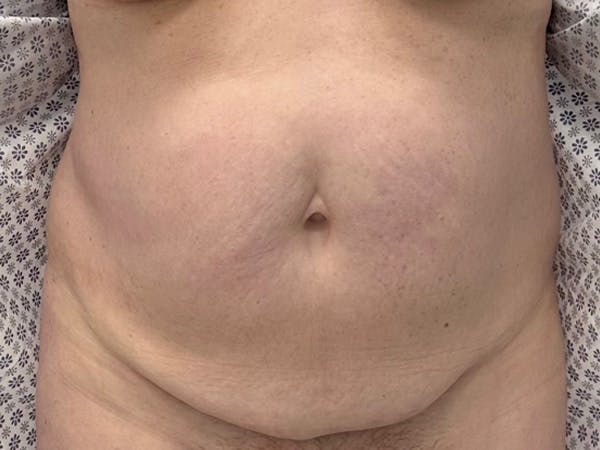 Tummy Tuck Before & After Gallery - Patient 210110 - Image 1