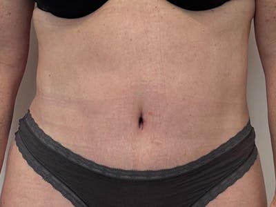 Tummy Tuck Before & After Gallery - Patient 210110 - Image 2
