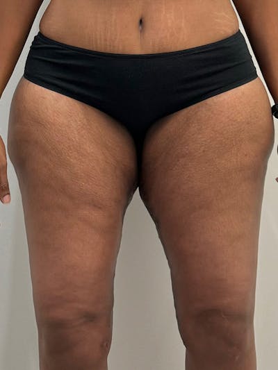 Thigh Lift Before & After Gallery - Patient 499508 - Image 2