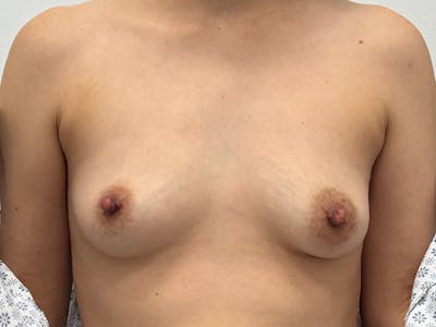 Breast Augmentation Before & After Gallery - Patient 436424 - Image 1