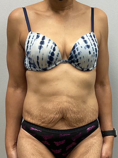 Liposuction Before & After Gallery - Patient 271690 - Image 1