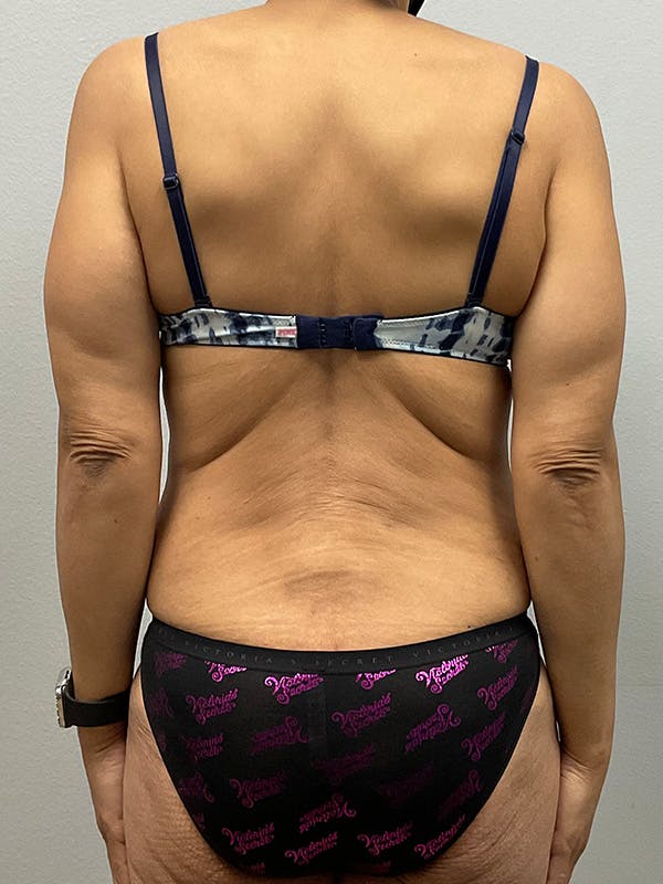 Tummy Tuck Before & After Gallery - Patient 233165 - Image 3