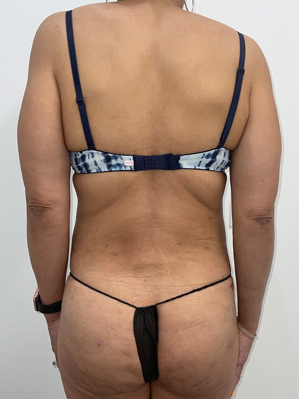 Tummy Tuck Before & After Gallery - Patient 233165 - Image 4