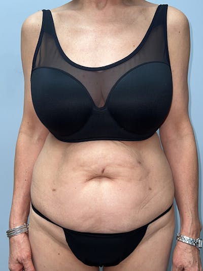 Tummy Tuck Before & After Gallery - Patient 345052 - Image 1