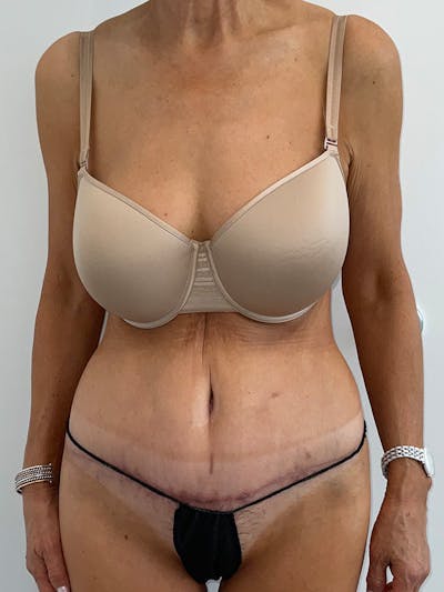 Liposuction Before & After Gallery - Patient 477491 - Image 2