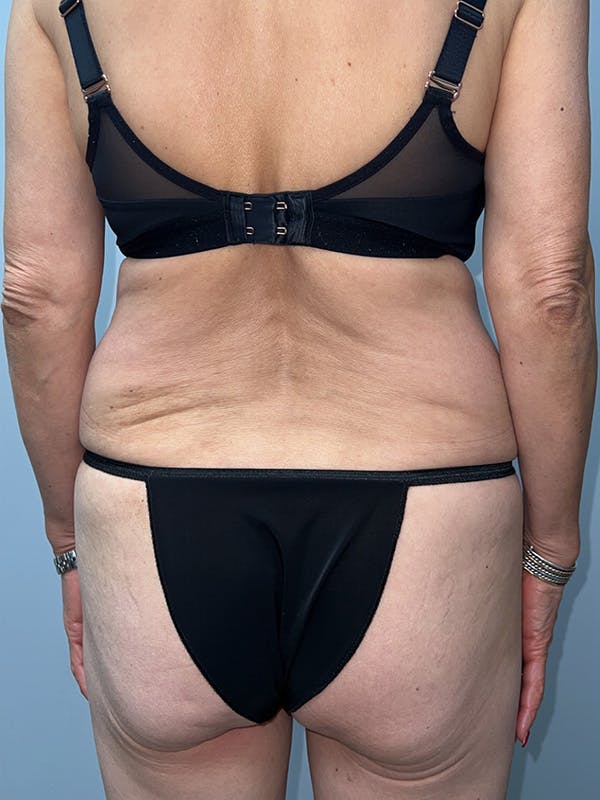 Butt Lift Before & After Gallery - Patient 197780 - Image 3
