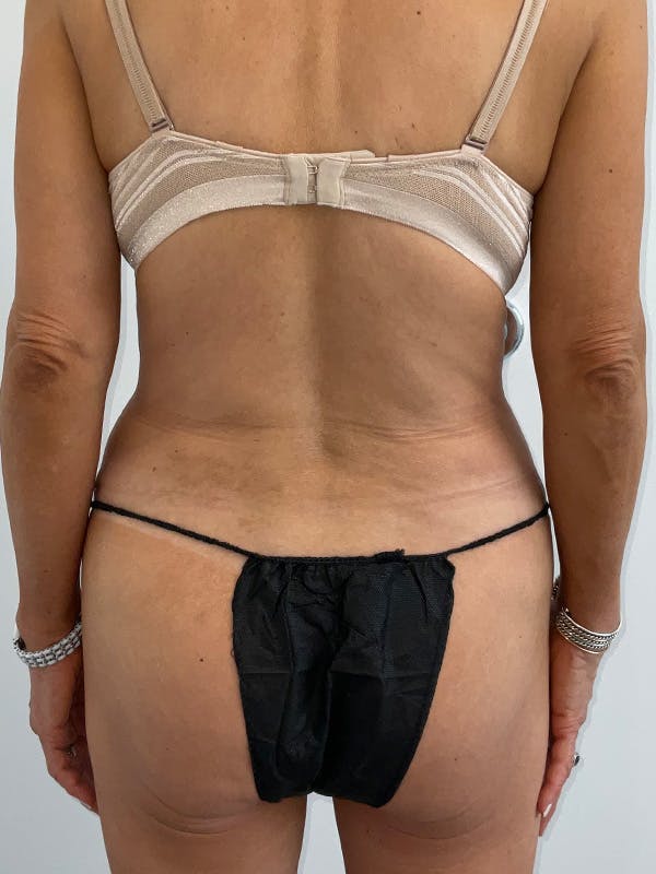 Butt Lift Before & After Gallery - Patient 197780 - Image 4