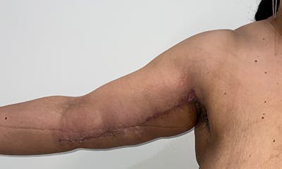 Arm Lift Before & After Gallery - Patient 354092 - Image 2