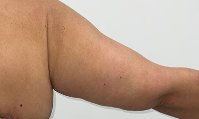 Arm Lift Before & After Gallery - Patient 354092 - Image 4