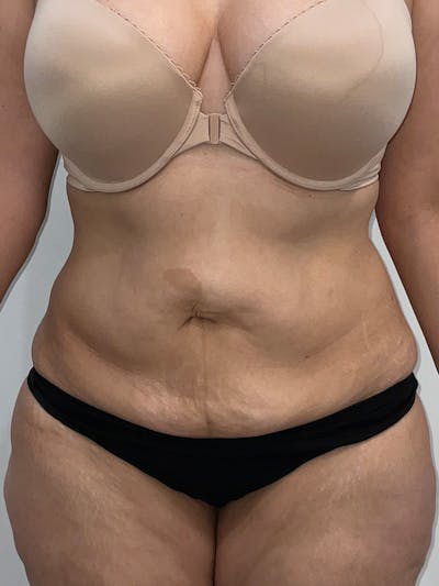 Tummy Tuck Before & After Gallery - Patient 294271 - Image 1