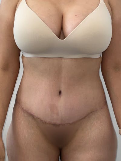 Tummy Tuck Before & After Gallery - Patient 294271 - Image 2