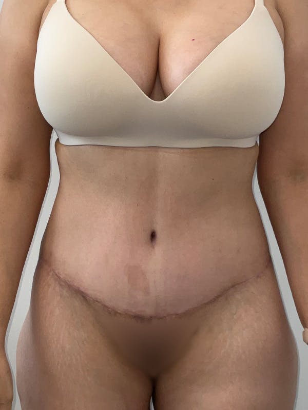 Tummy Tuck Before & After Gallery - Patient 294271 - Image 2