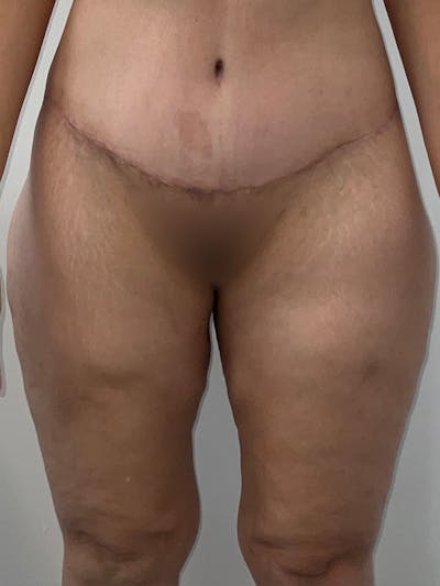 Thigh Lift Before & After Gallery - Patient 401107 - Image 2