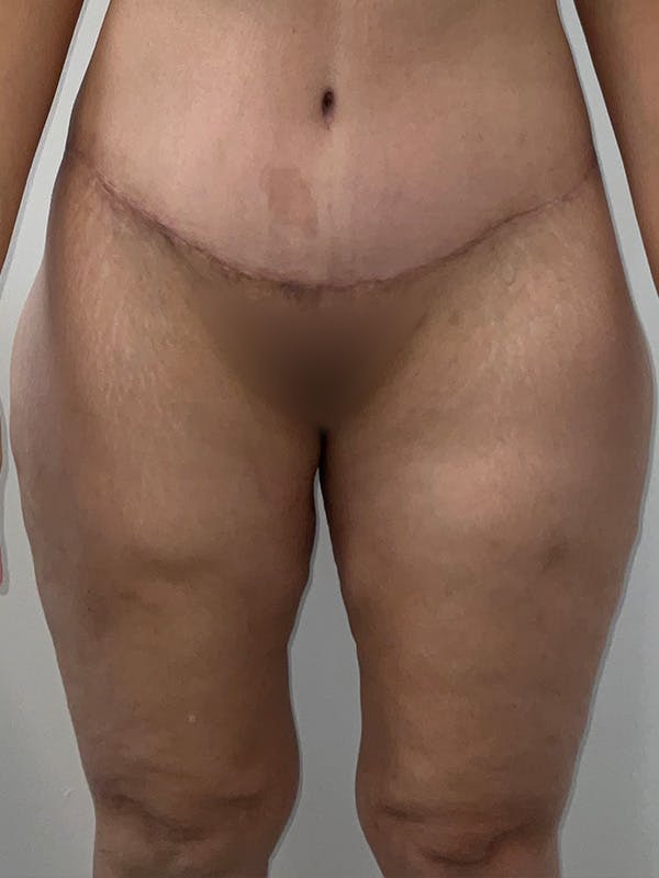 Thigh Lift Before & After Gallery - Patient 401107 - Image 2