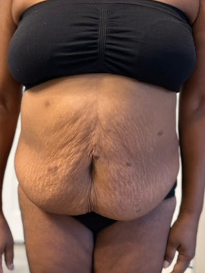 Tummy Tuck Before & After Gallery - Patient 392214 - Image 1