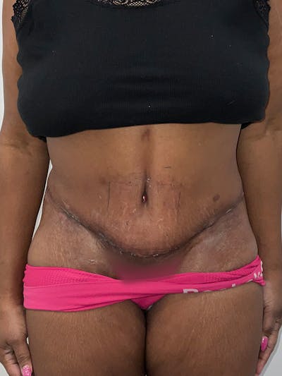 Tummy Tuck Before & After Gallery - Patient 392214 - Image 2