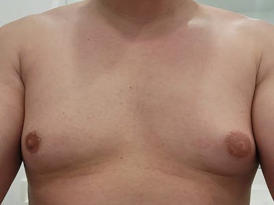 Gynecomastia Before & After Gallery - Patient 130581 - Image 1