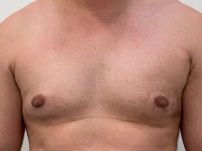 Gynecomastia Before & After Gallery - Patient 130581 - Image 2