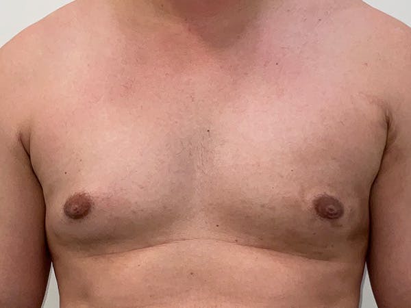 Gynecomastia Before & After Gallery - Patient 130581 - Image 2