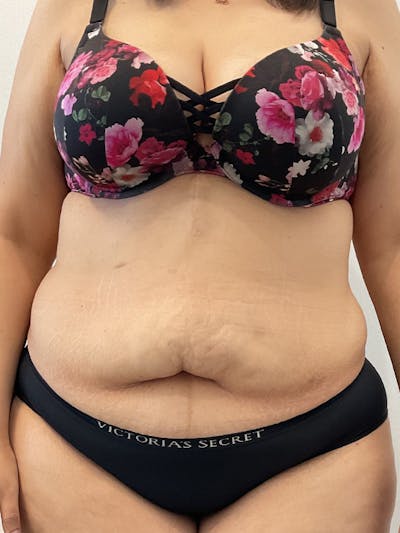 Tummy Tuck Before & After Gallery - Patient 167409 - Image 1