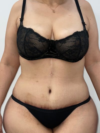 Tummy Tuck Before & After Gallery - Patient 167409 - Image 2
