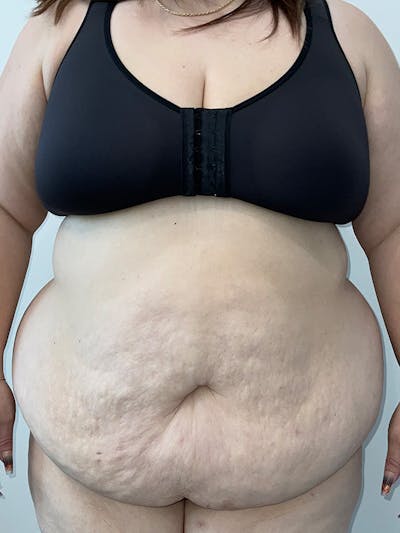 Tummy Tuck Before & After Gallery - Patient 193082 - Image 1