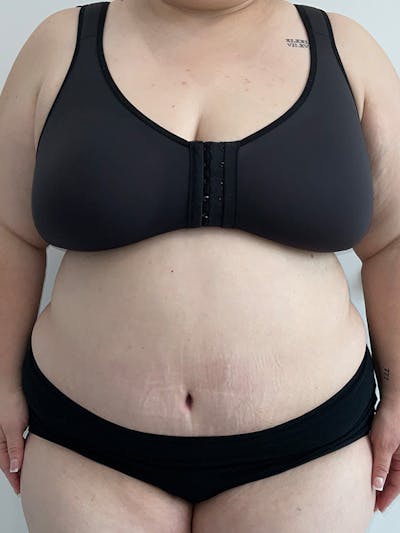 Tummy Tuck Before & After Gallery - Patient 193082 - Image 2