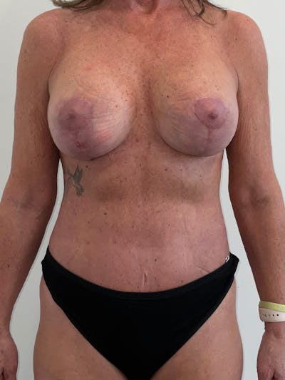 Tummy Tuck Before & After Gallery - Patient 282645 - Image 2