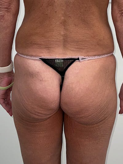 Butt Lift Before & After Gallery - Patient 175692 - Image 1