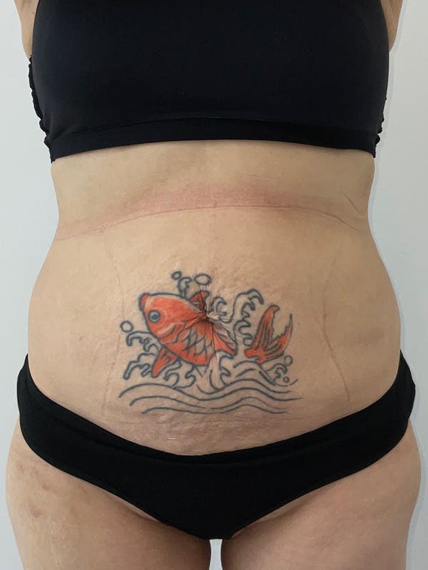 Tummy Tuck Before & After Gallery - Patient 440783 - Image 1