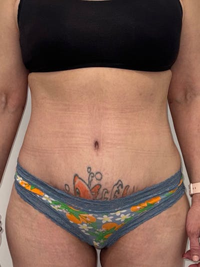 Tummy Tuck Before & After Gallery - Patient 440783 - Image 2