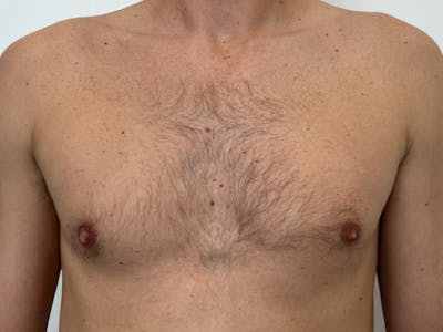 Gynecomastia Before & After Gallery - Patient 148037 - Image 1